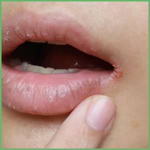 Cracked lip corners reasons